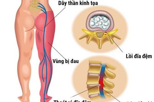 Cách chữa đau thần kinh tọa, có khỏi không?