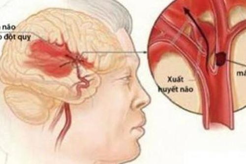 'Thủ phạm' ít được để ý nhưng nguy cơ cao gây đột quỵ não