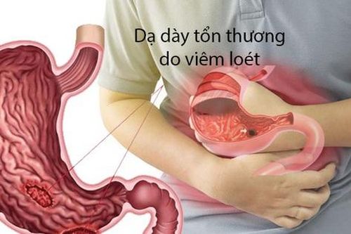 Căng thẳng dễ gây đau bụng, đau dạ dày