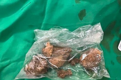 Tắc ruột vì ăn hồng ngâm, cô gái 23 tuổi phải nhập viện cấp cứu