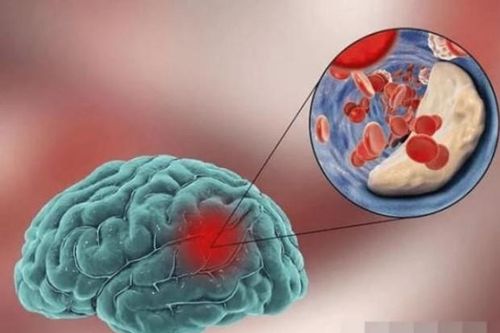 'Chất gia tốc' cho bệnh nhồi máu não không chỉ là muối, bác sĩ nhắc nhở: ba loại gia vị này cho vào nồi càng ít càng tốt