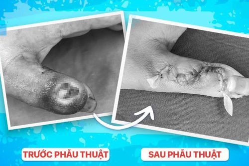 Đắp lá thuốc để chữa nhọt khiến ngón tay bị hoại tử