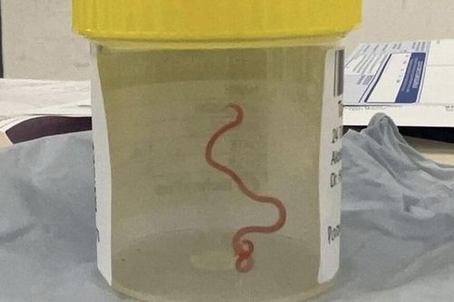 Giun dài 8cm ký sinh trong não khiến bệnh nhân 'đãng trí và trầm cảm'