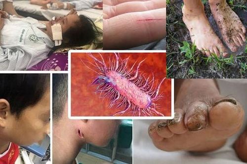 Tìm hiểu về 'vi khuẩn ăn thịt người' và nguyên nhân nhiễm bệnh