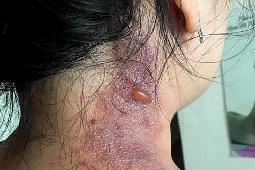 Cách phòng ngừa và xử lý hiệu quả khi bị kiến ba khoang đốt