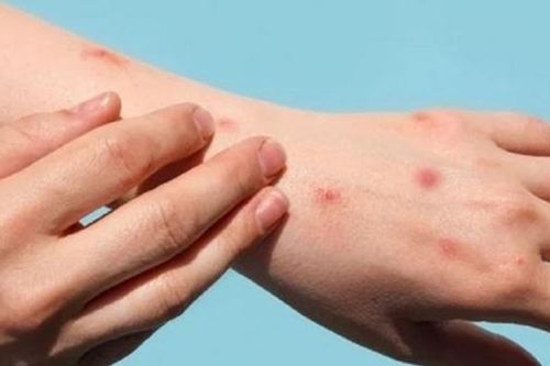 Phát hiện 2 bệnh nhân HIV nhiễm đậu mùa khỉ