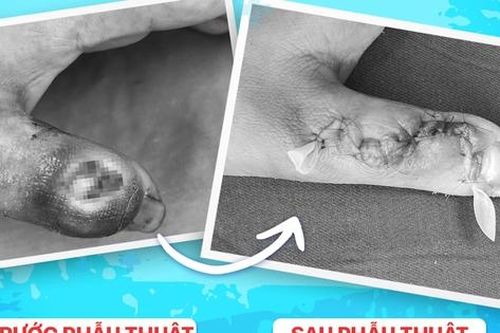 Hoại tử ngón tay do tự ý đắp thuốc lá của thầy lang