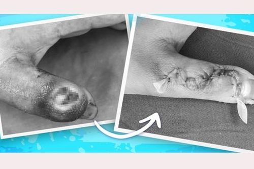 Bệnh nhi suýt mất ngón tay vì đắp thuốc lá