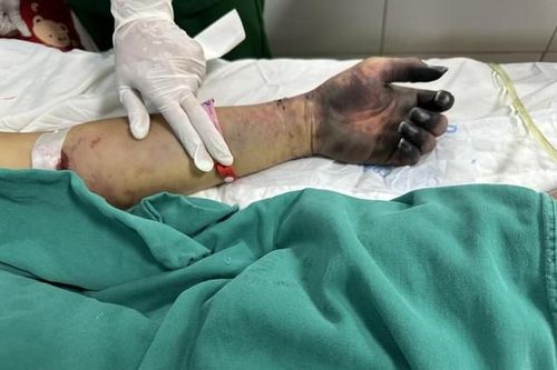Người đàn ông ở Nghệ An phải cắt bỏ 2 chân, ngón tay do nhiễm liên cầu lợn