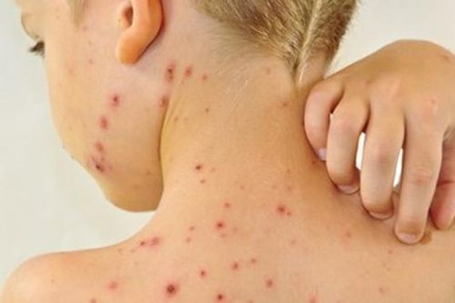 Phân biệt bệnh thủy đậu và tay chân miệng ở trẻ em