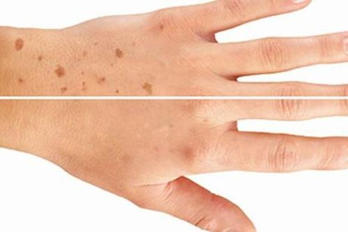 Cách đơn giản xóa đốm đồi mồi trên da tại nhà