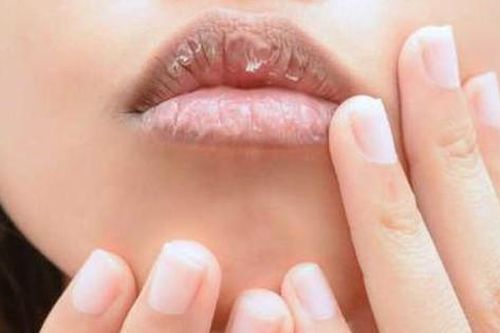 Môi khô, nứt nẻ, đau rát khó lành cảnh giác với ung thư môi