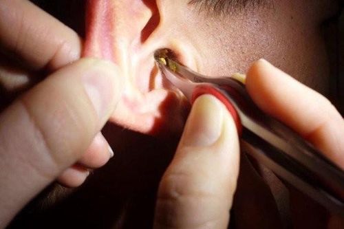 Lấy ráy tai không đúng cách có thể gây điếc vĩnh viễn