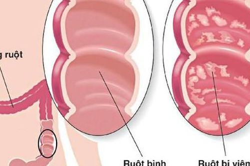 Thuốc mới điều trị viêm loét đại tràng