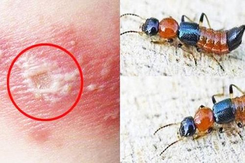 Làm gì khi bị kiến ba khoang đốt?