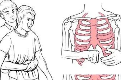 Xử trí nghẹn thức ăn, hóc dị vật bằng nghiệm pháp Heimlich cần biết những điều này
