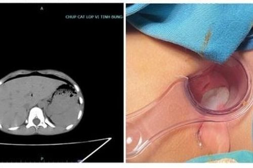 Phú Thọ: Bé 8 tuổi bị thủng trực tràng do bạn cùng lớp nghịch dại