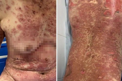 Sau dùng thuốc nam trị sỏi thận, một phụ nữ bị lở loét toàn thân