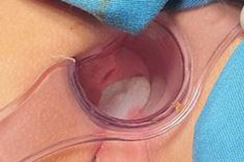 Tai nạn hi hữu: Bé 8 tuổi bị bút bi đâm thủng trực tràng do bạn cùng lớp nghịch dại