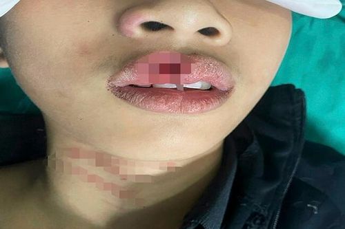 Ngậm que gỗ chơi, bé 3 tuổi bị đâm thủng vòm hầu