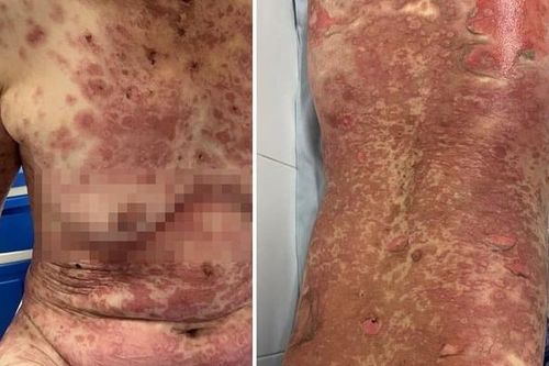 Tự ý dùng thuốc nam điều trị bệnh, nhiều trường hợp bị dị ứng nặng