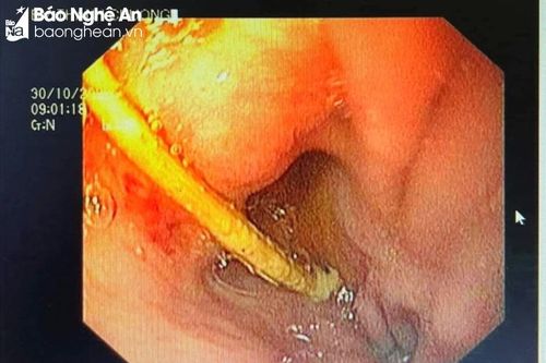 Gắp thành công tăm tre dài 5cm trong dạ dày bệnh nhân