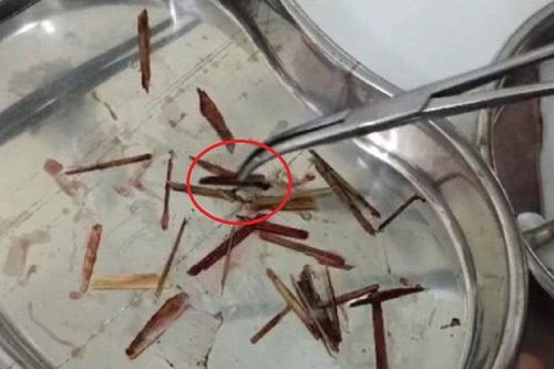 Soi vào mũi, phát hiện 33 que nứa trong mũi nữ bệnh nhân