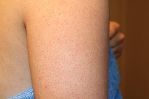 Trị dày sừng nang lông tại nhà khi thời tiết lạnh