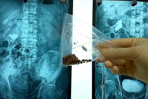 Sỏi thận có tự hết không?