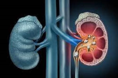 Triệu chứng bệnh sỏi thận dễ bị bỏ qua