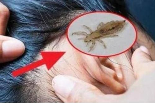 Những sinh vật đã đồng hành cùng con người lâu nhất ở khắp mọi nơi cách đây 30 năm, tại sao bây giờ chúng ta không thấy chấy rận?