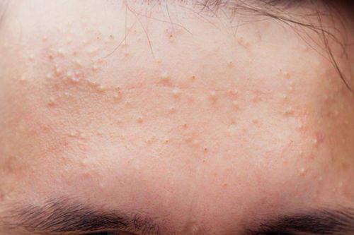 Nổi mụn ẩn trên trán phải làm sao?