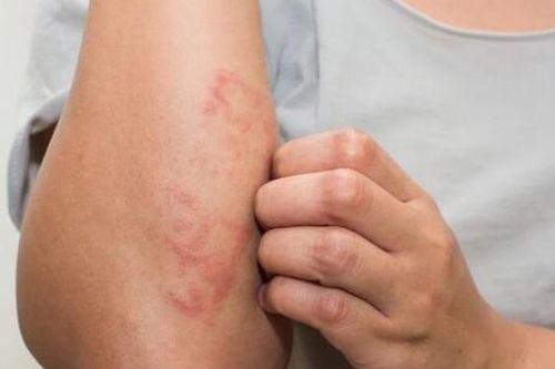 Cách chăm sóc da ở người bệnh chàm trong mùa hanh khô