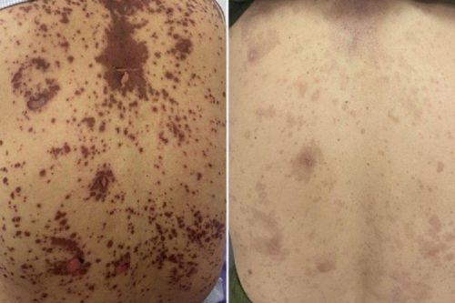 Dùng thuốc nam, người phị nữ U60 da bỗng đỏ thẫm và nhăn nheo
