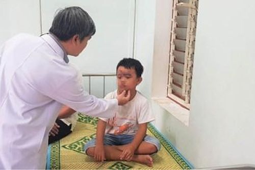 Không coi thường viêm bỏng da do kiến ba khoang