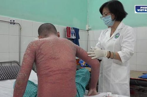 Cảnh báo việc bệnh nhân sử dụng thuốc chữa vảy nến mua qua mạng xã hội