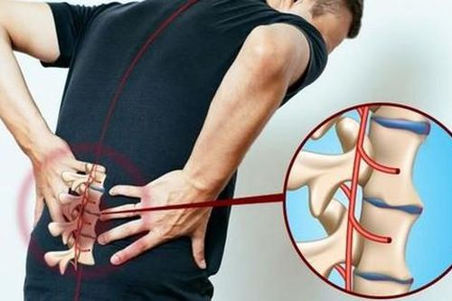 3 lưu ý khi mắc viêm cột sống dính khớp tránh tàn phế
