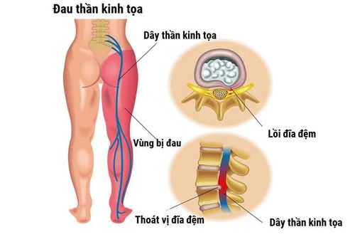 Cách chữa đau thần kinh tọa, có khỏi không?