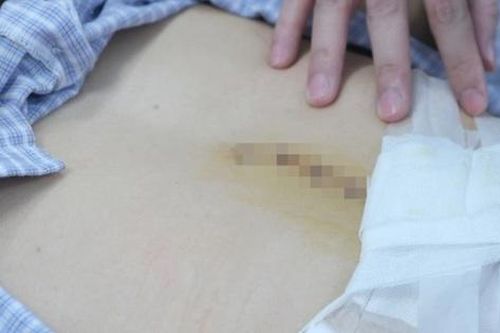 Nam sinh 16 tuổi phải cắt dạ dày vì thói quen nguy hiểm nhiều bạn trẻ đang mắc