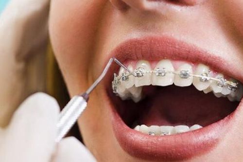 Vì sao người niềng răng nên sử dụng nước súc miệng