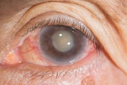 Suy giảm thị lực do đâu và cách điều trị tốt nhất