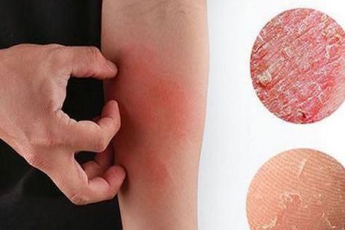 4 bài thuốc bổ huyết phòng ngừa da khô mùa đông