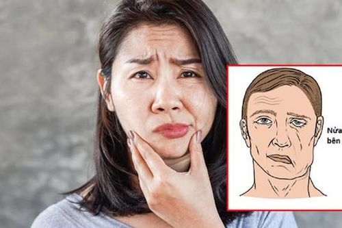Cẩn trọng với bệnh liệt mặt mùa lạnh