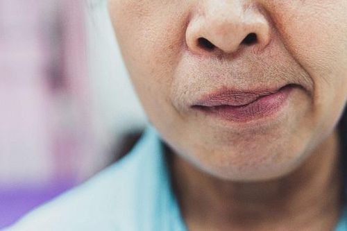 Chữa liệt mặt mùa lạnh cần chú ý những điều này