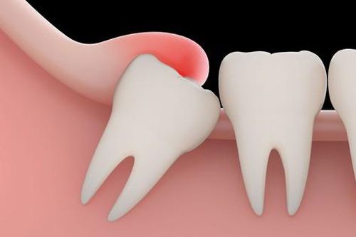 Răng khôn mọc lệch, ngầm gây biến chứng gì?