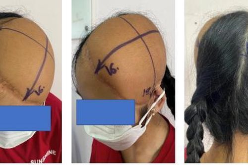 Tái tạo da đầu mang tóc bằng kỹ thuật giãn mô