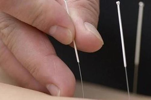 Phục hồi di chứng viêm não bằng châm cứu, bấm huyệt