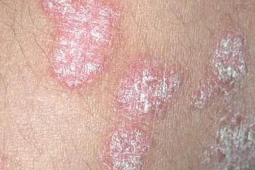 Trị bệnh vẩy nến bằng Đông y