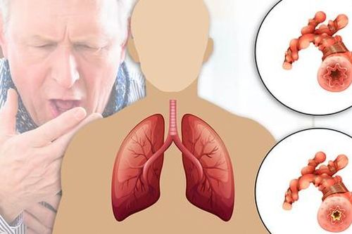 Bệnh phổi tắc nghẽn mạn tính (COPD): Nóng lạnh đan xen dễ bùng phát các đợt cấp của COPD
