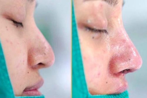 Biến chứng nặng sau nâng mũi phong thủy